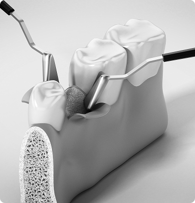 Chirurgies des gencives & greffes gingivales