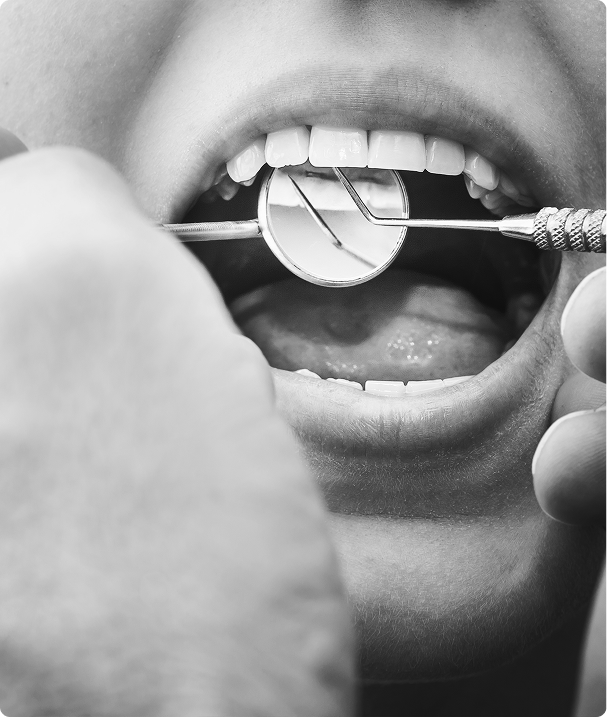 Comment traite-t-on une carie ? Comment traite-t-on une carie ?