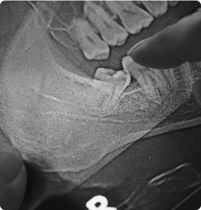 Extraction des dents de sagesse