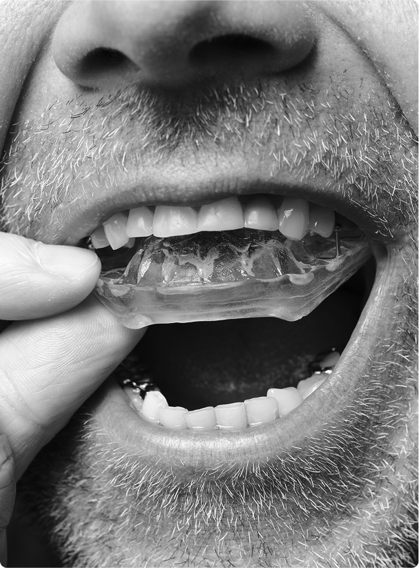 Gouttière Michigan: 
une solution sur mesure