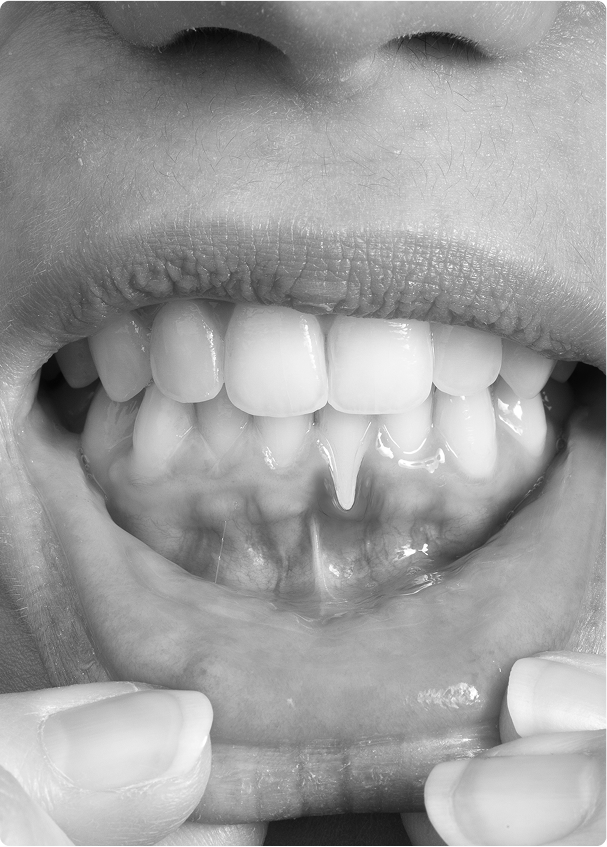 Quand une chirurgie gingivale est-elle indiquée ?