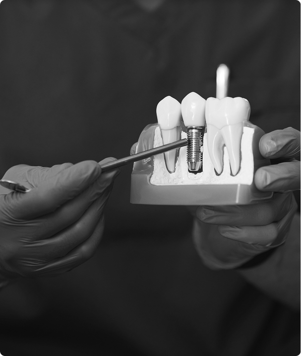 Qu’est-ce qu’un implant dentaire ?