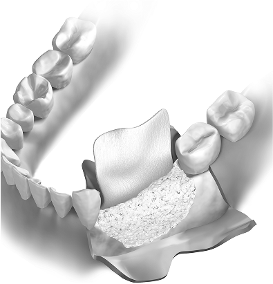 Régénération osseuse guidée