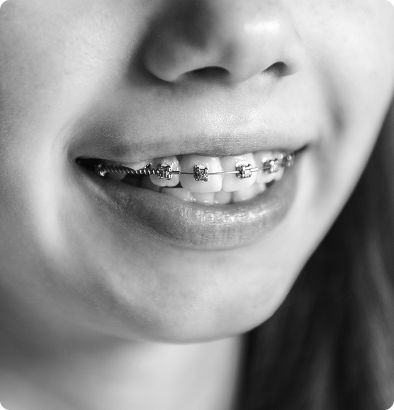 Traitements interceptifs pour enfants Traitements interceptifs pour enfants