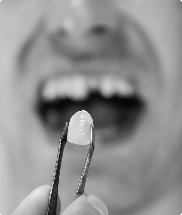 Une solution moderne et durable pour remplacer les dents manquantes